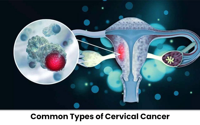 Cervical Cancer