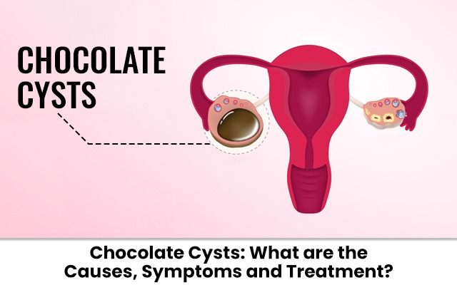Chocolate Cysts Explained: Causes, Symptoms, Diagnosis, and Treatment Options