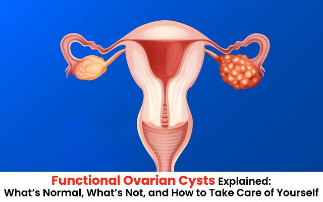 Functional Ovarian Cysts Explained: What’s Normal, What’s Not, and How to Take Care of Yourself
